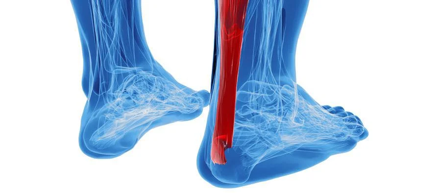 Anatomical illustration highlighting the Achilles tendon