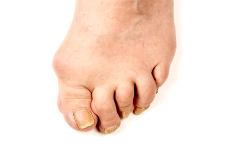 Foot showing joint deformity from arthritis