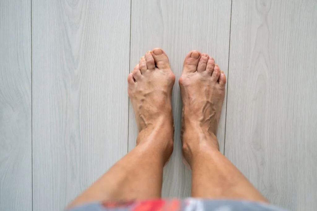 Feet showing a visible bunion deformity at the big toe joint