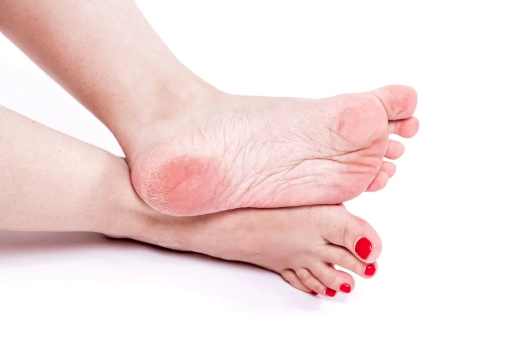 Foot showing thickened callus on heel