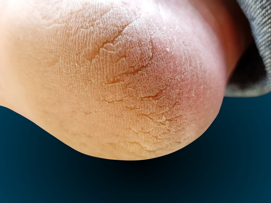 Close-up of dry, cracked heel skin