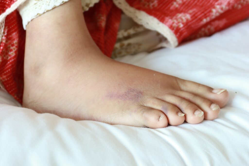 Close-up of foot showing skin bruising and discoloration