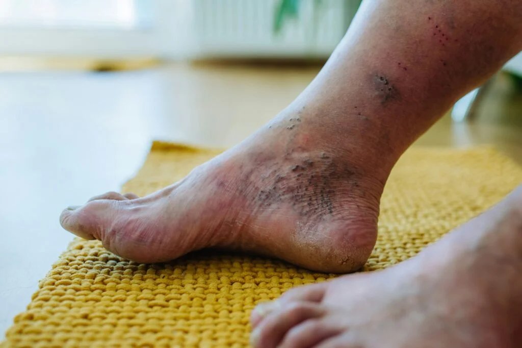 Ankle with skin discoloration and wound marks