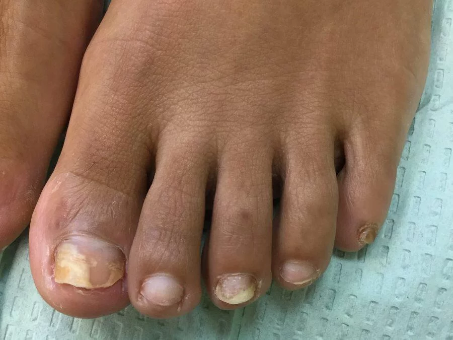 Toenails showing signs of fungal infection