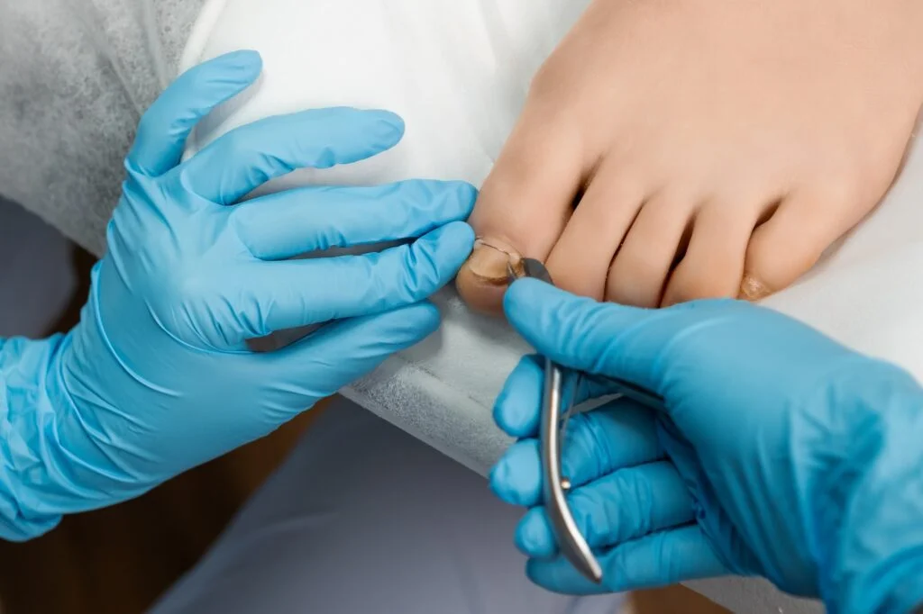 Provider treating ingrown toenail with instrument