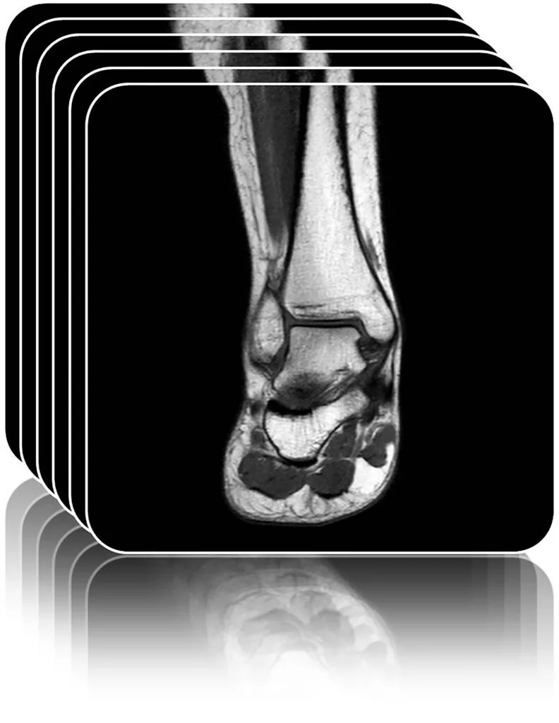 Stack of MRI scan images showing the ankle and foot