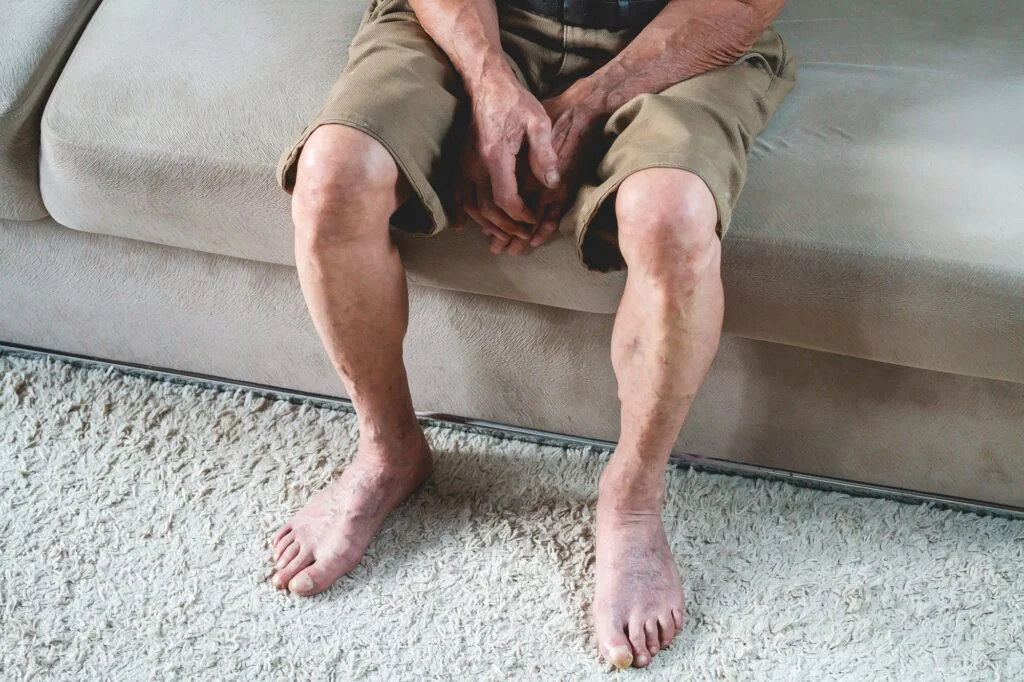 Legs showing signs of poor circulation