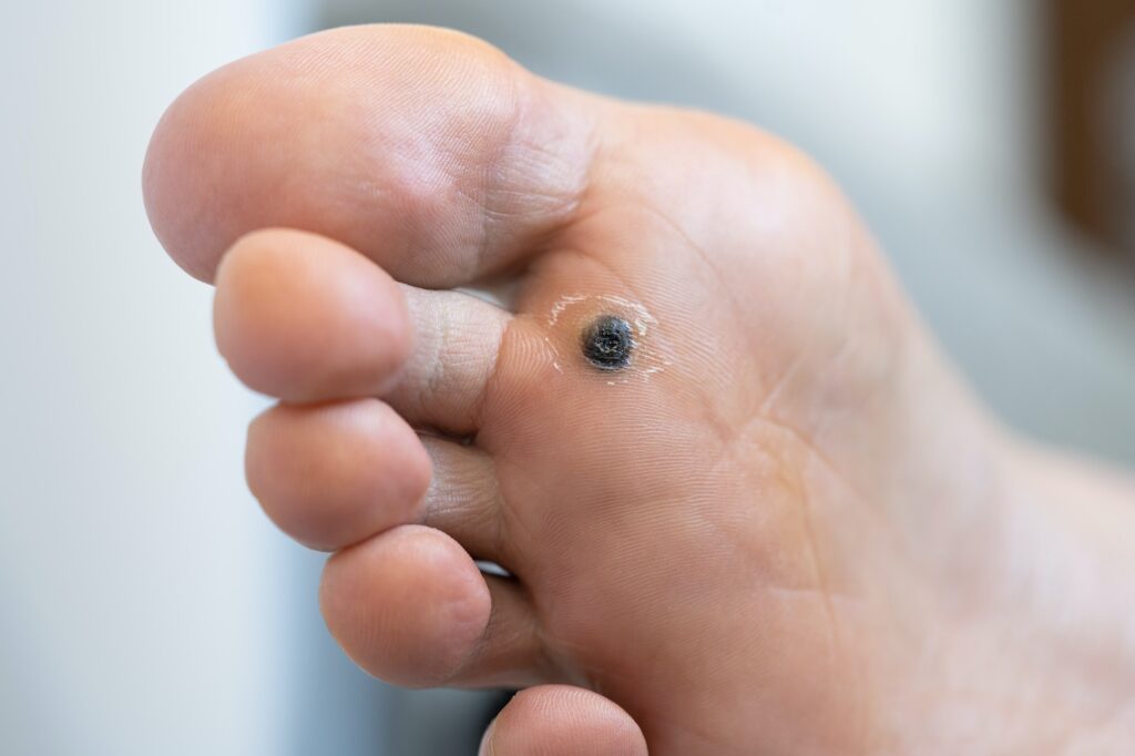 Close-up of plantar wart on sole of foot